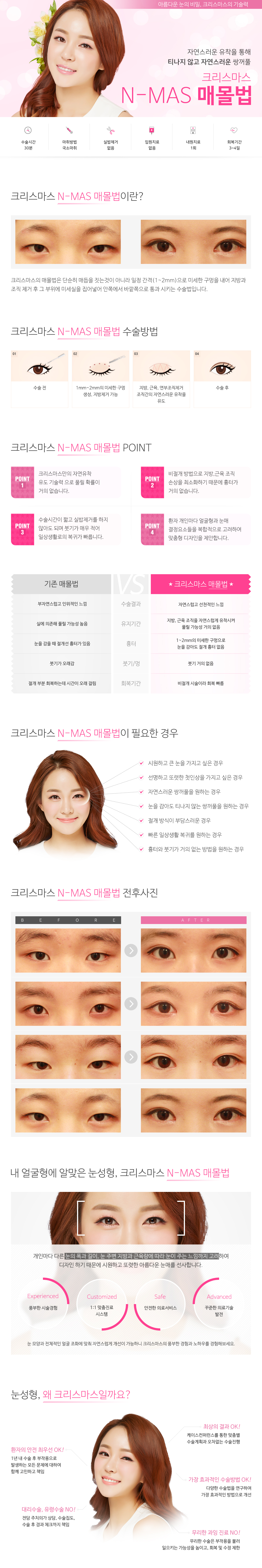 시크릿매몰법/쌍커풀(매몰)
