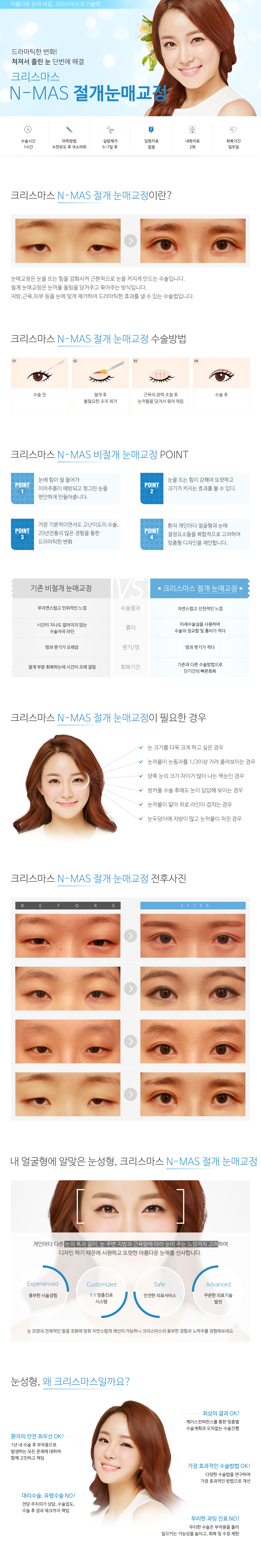 절개눈매교정/눈매교정(절개)